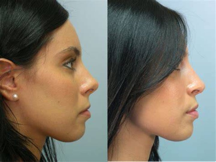 How much is a nose job?
