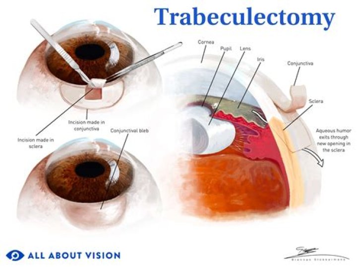 How safe is a trabeculectomy?