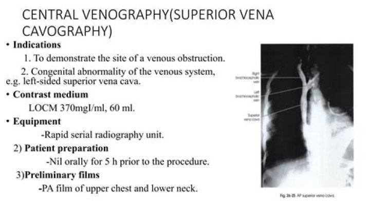 How serious is a venogram?