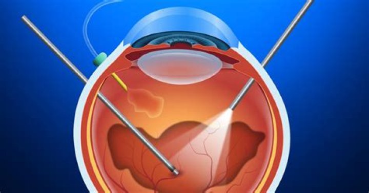 Is a vitrectomy a serious operation?