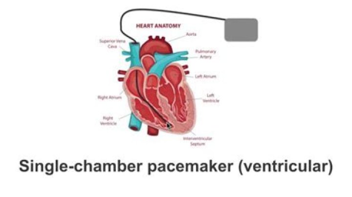 Is an ICD heart starter the same as a pacemaker?
