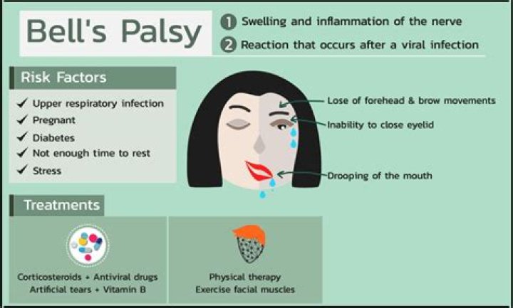 Is Bell's palsy fatal?