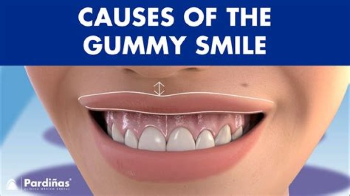 Is gummy smile the same as lip flip?