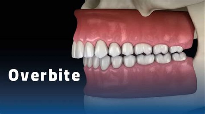 Is it necessary to fix overbite?
