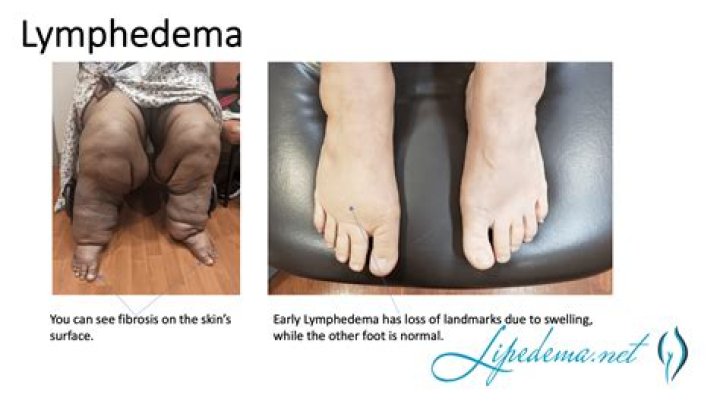 Is lymphedema acute or chronic?