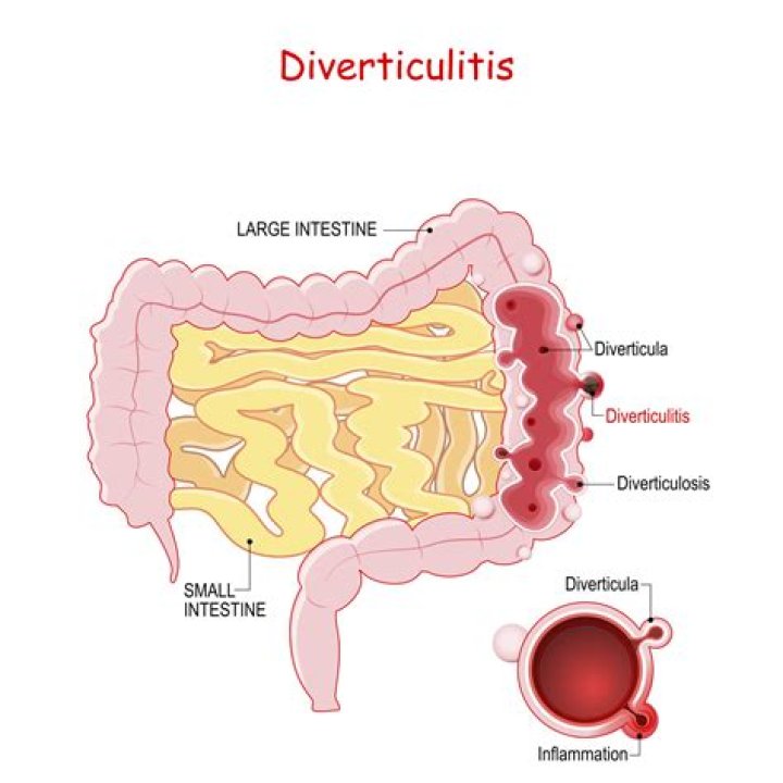 Is there a maintenance drug for diverticulitis?