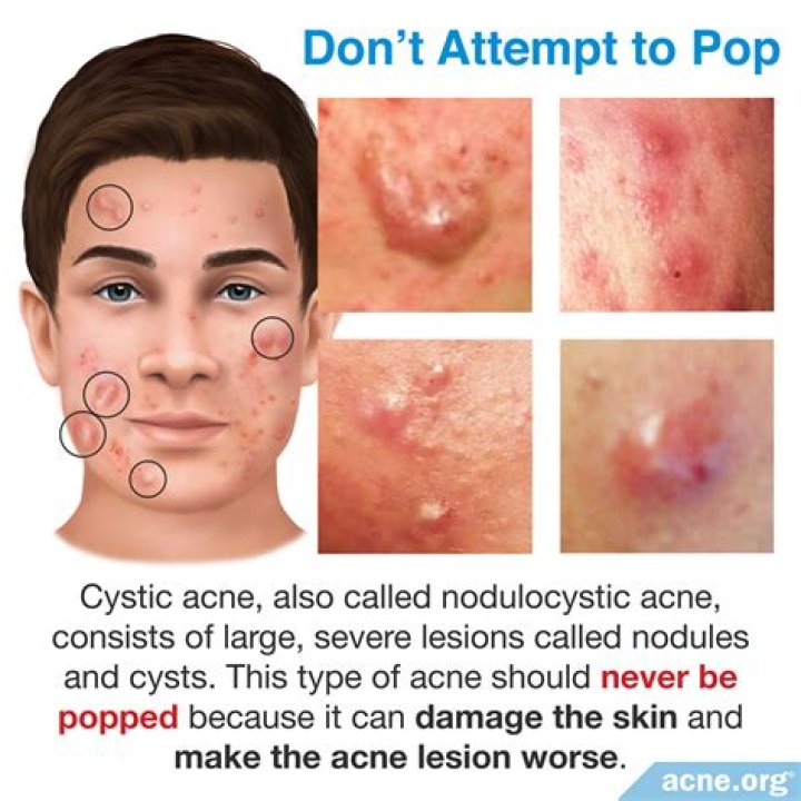 Should you pop a pimple if it has a white head?