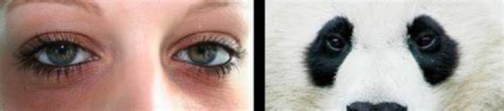 What are panda eyes caused from?