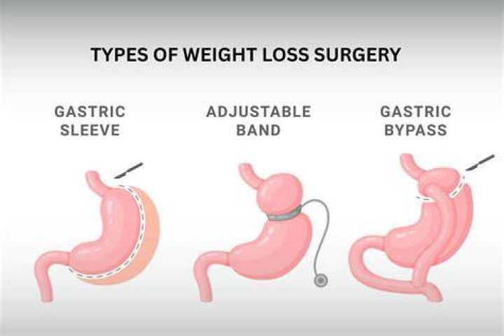 What are the characteristics of weight loss surgery?