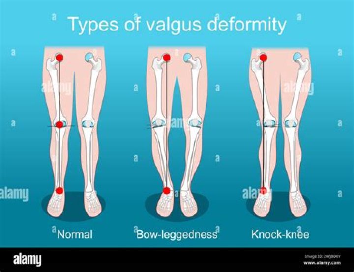 What are the types of deformity?
