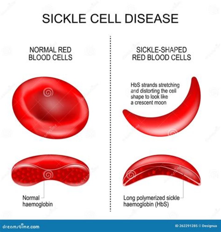 What blood type carries sickle cell?