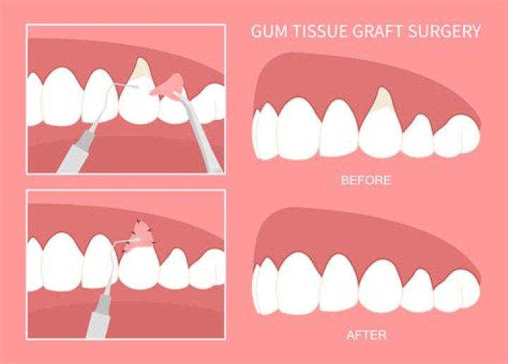 What can you not do after a gum graft?