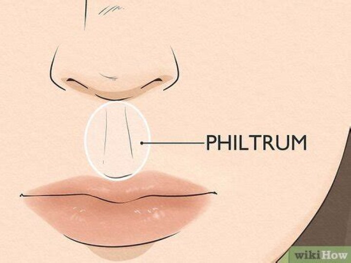What causes no philtrum?