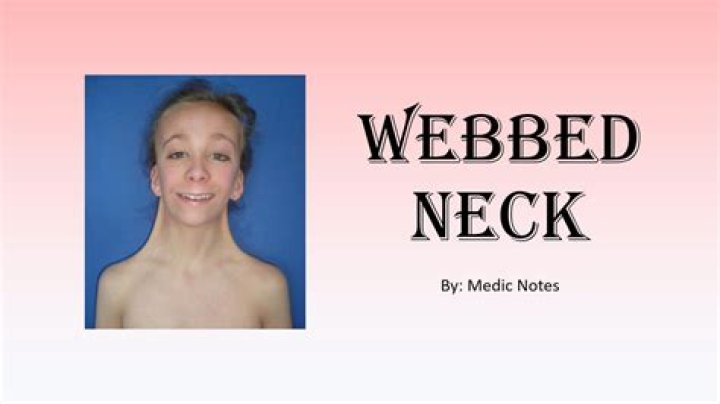 What causes webbed neck?