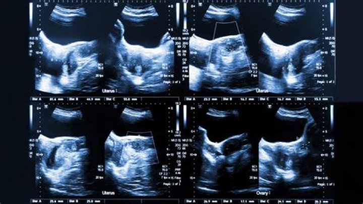 What does a limited abdominal ultrasound show?