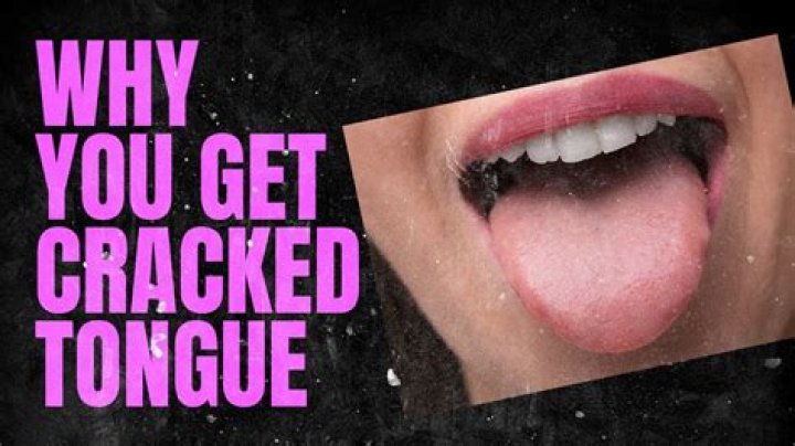 What does cracks in tongue mean?