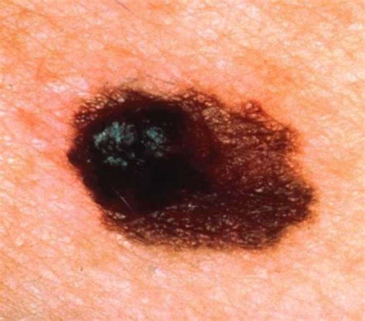 What does nodular melanoma look like?