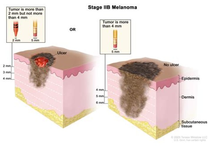 What foods can cure melanoma?