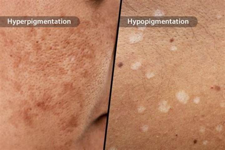 What foods help hypopigmentation?