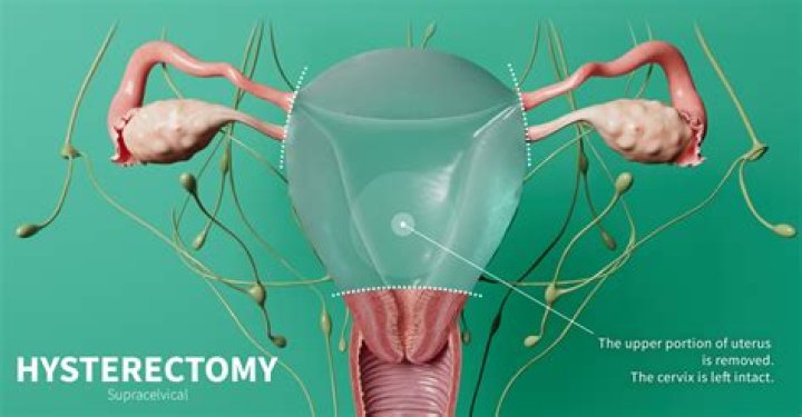What happens to vaginal opening after hysterectomy?