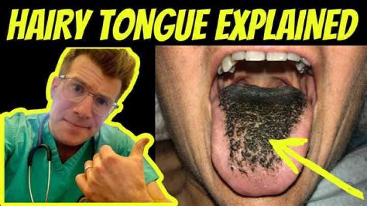 What is a black hairy tongue called?