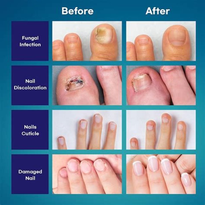 What is the best cure for thick toenails?