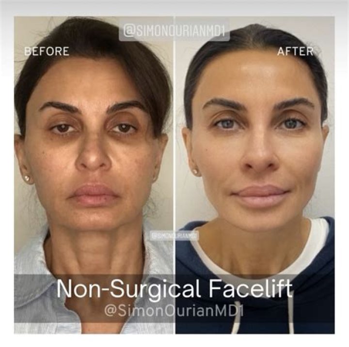 What is the best non-surgical treatment for face?