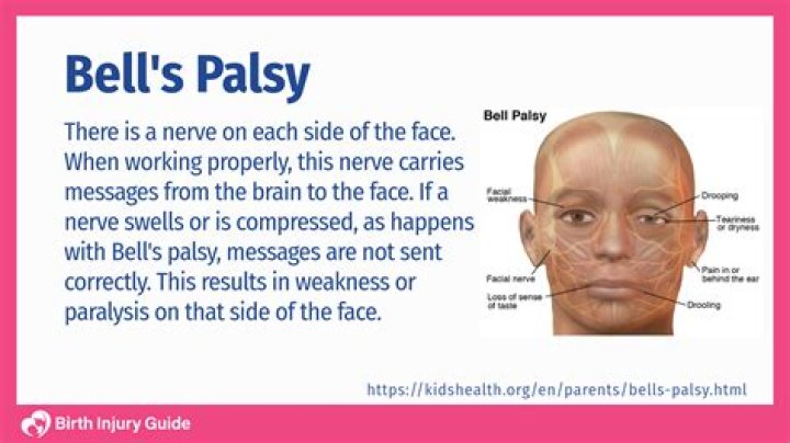 What is the fastest way to cure Bell's palsy?