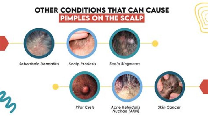 What is the hard seed that comes out of a pimple?