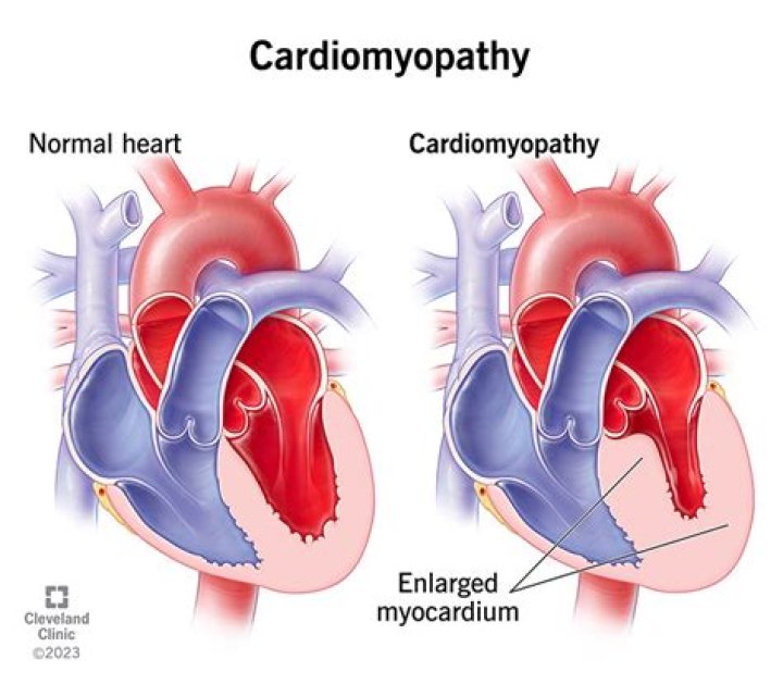 What is the main cause of cardiomyopathy?