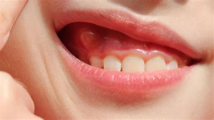 What is the skin between your gums and lip called?