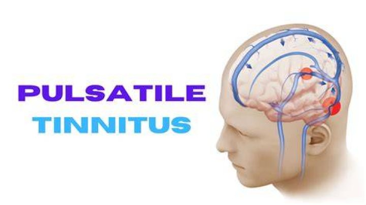 What medications can cause pulsatile tinnitus?
