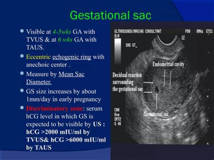 When is the sac visible on ultrasound?