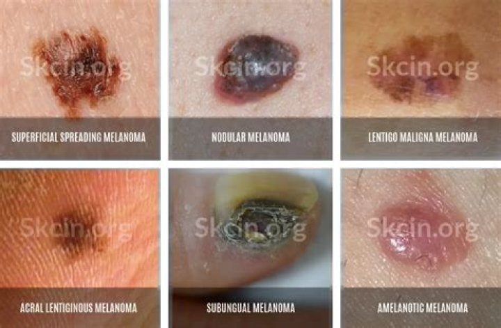 Where does scalp melanoma spread first?