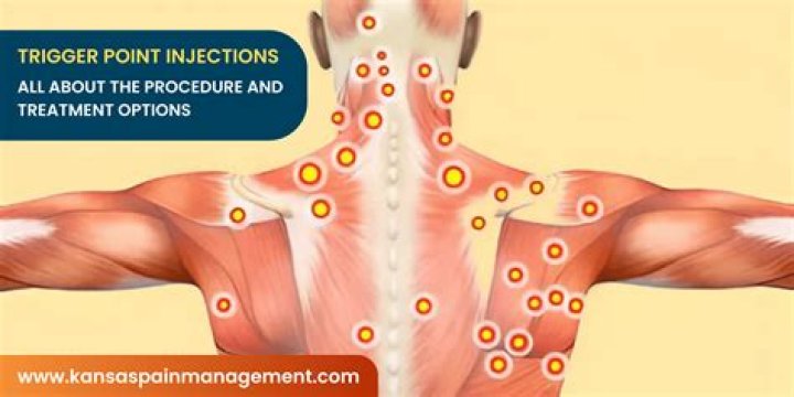 Where is the trigger point for sciatica?