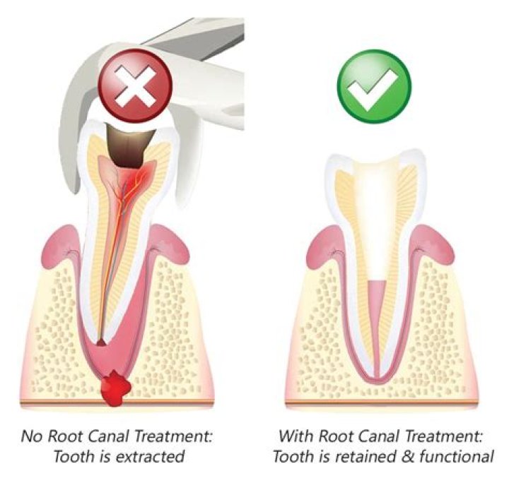 Which is more painful tooth extraction or root canal?