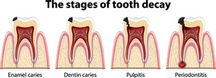 Why do dentists tap on teeth?