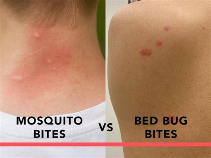 Why do mosquito bites get so big?