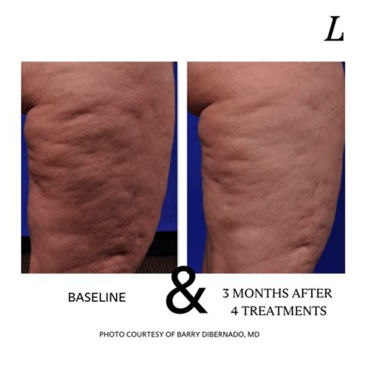 Will I always have cellulite?