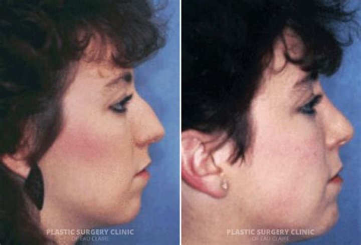 Will wearing a mask ruin my rhinoplasty?
